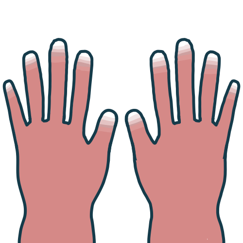 混合性結合組織病