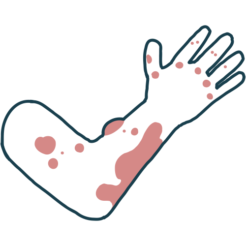 サルコイドーシス