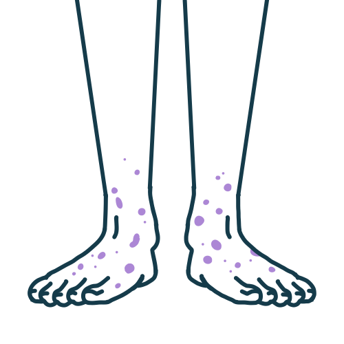 顕微鏡的多発血管炎