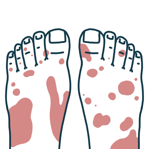 結節性多発動脈周囲炎